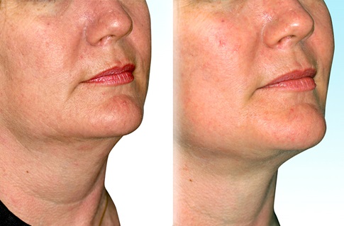 Before & After: Face Procedures - Penn Medicine Cosmetic Services
